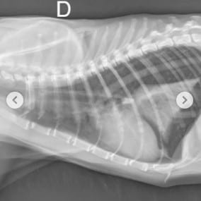 Shaguy - lobectomie pulmonaire (vue de côté)